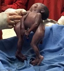 В Индии родились сиамские близнецы с одной головой и одним лицом